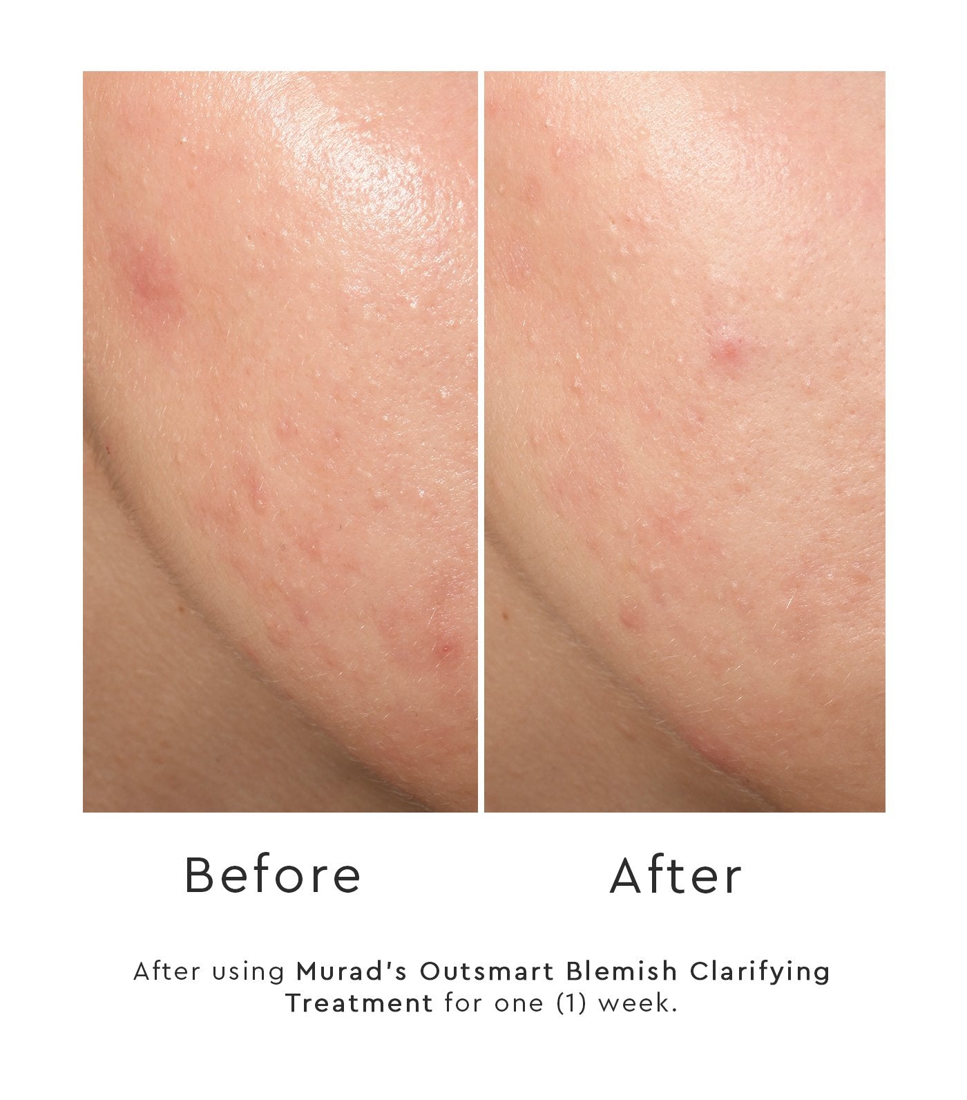 Murad Outsmart Blemish™ Clarifying Treatment